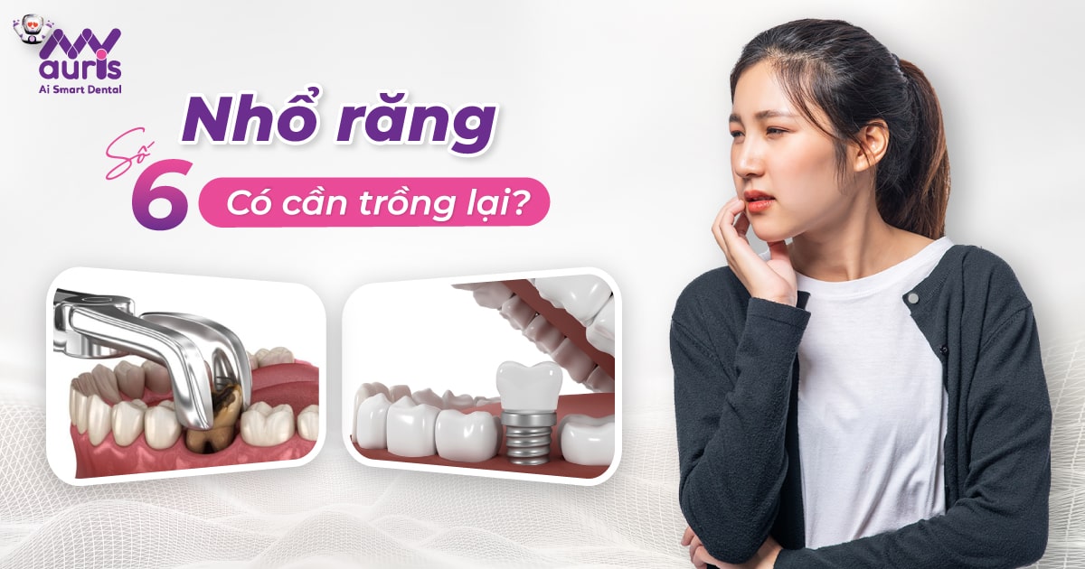 Nhổ răng số 6 có cần trồng lại không? Bao lâu nên trồng?