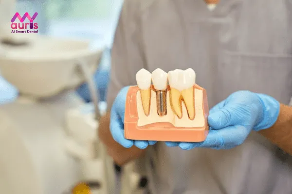 Trồng răng Implant - Phương pháp phục hình răng số 7 hiệu quả, an toàn 