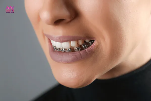 Niềng răng 1 hàm dưới là như thế nào?