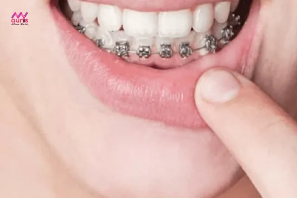Chỉ niềng răng 1 hàm dưới được không? 
