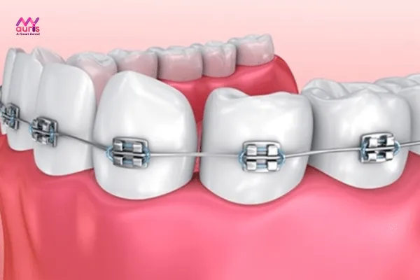 Giá niềng răng 1 hàm dưới có tiết kiệm hơn so với cả 2 hàm không? 