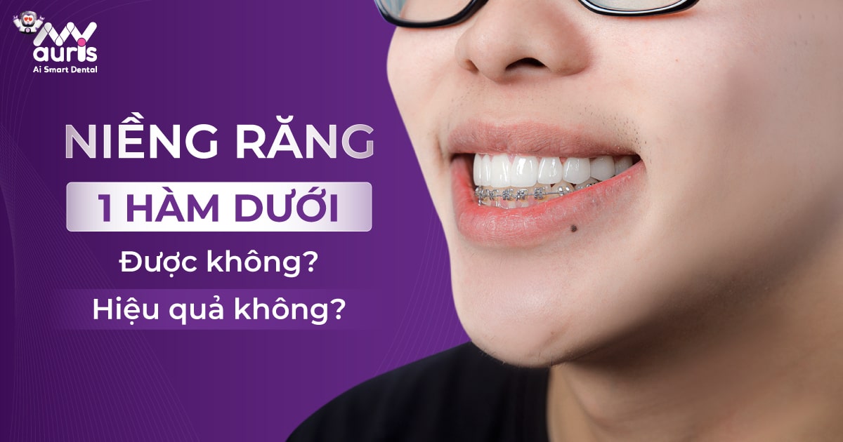 Niềng răng 1 hàm dưới được không?