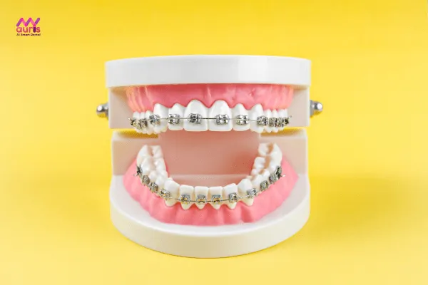 Niềng răng mắc cài kim loại - Niềng răng bằng phương pháp nào? 
