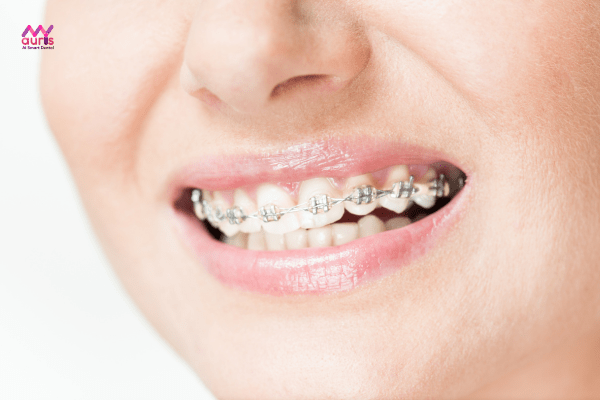 Niềng răng 2 lần có nên thực hiện không? Liệu có ảnh hưởng sức khỏe? 