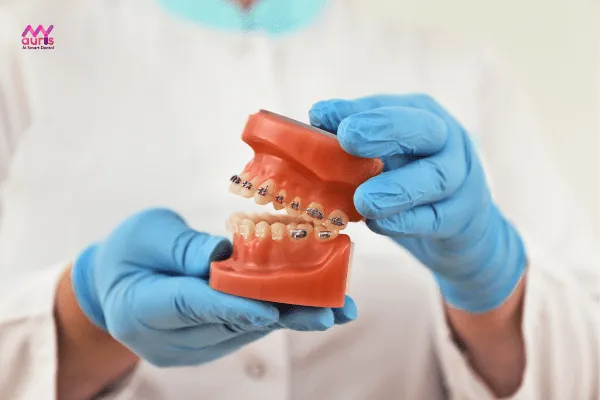 Niềng răng 2 lần quy trình có giống nhau không? 