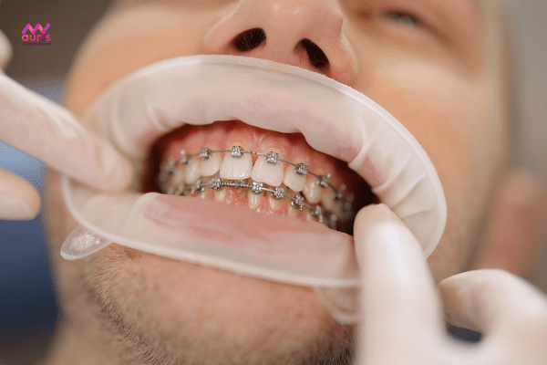 Giai đoạn làm đều răng trên cung hàm - Các giai đoạn niềng răng 