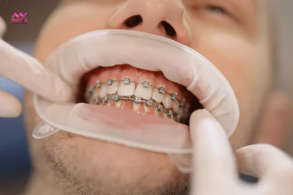 Giai đoạn làm đều răng trên cung hàm - Các giai đoạn niềng răng 