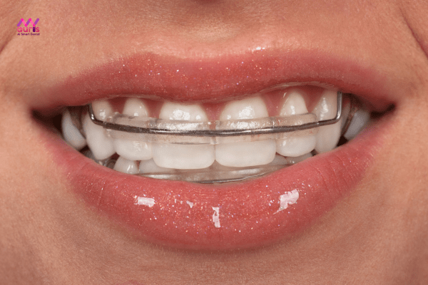 Tháo bỏ niềng răng và đeo hàm duy trì - Các giai đoạn niềng răng 
