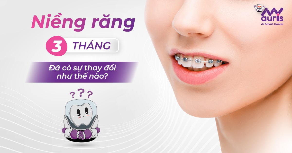 Niềng răng 3 tháng đã có sự thay đổi như thế nào?