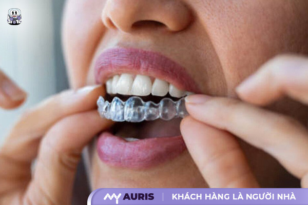 niềng răng 3d clear có hiệu quả không,niềng răng không mắc cài 3d clear,niềng răng 3d là gì