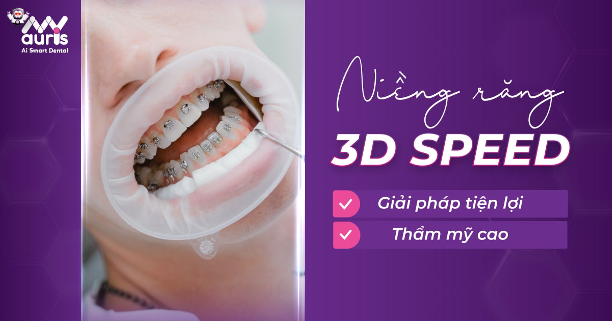 Niềng răng 3d speed