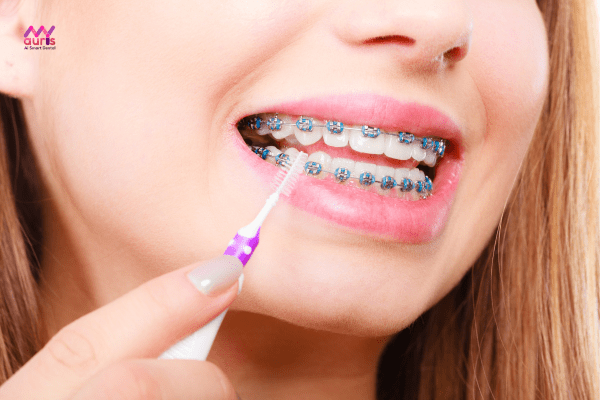 Kinh nghiệm vệ sinh răng miệng an toàn trong chỉnh nha 