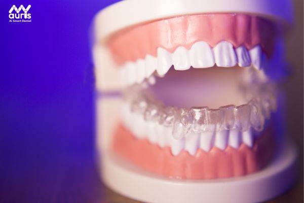 Niềng răng bằng invisalign hoạt động như thế nào? 