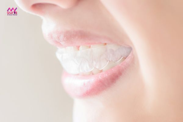 Niềng răng bằng khuôn cho người lớn có hiệu quả không? 
