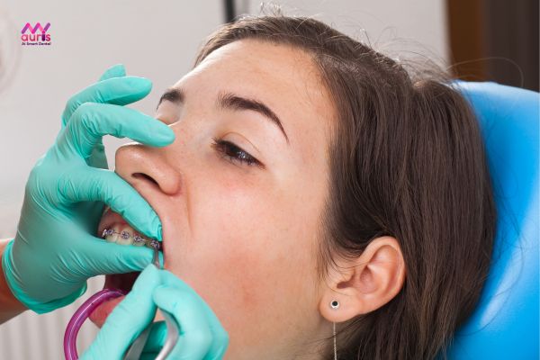 Niềng răng sai kỹ thuật - Nguyên nhân niềng răng bị buốt răng kéo dài 