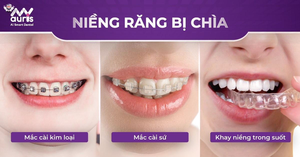 3 giải pháp niềng răng bị chìa - Kỹ thuật nào tốt nhất?