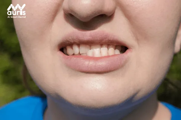 Răng bị cụp là răng gì?