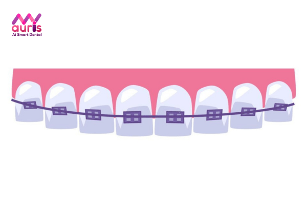 Chi tiết thời gian niềng răng bị cụp theo 2 phương pháp