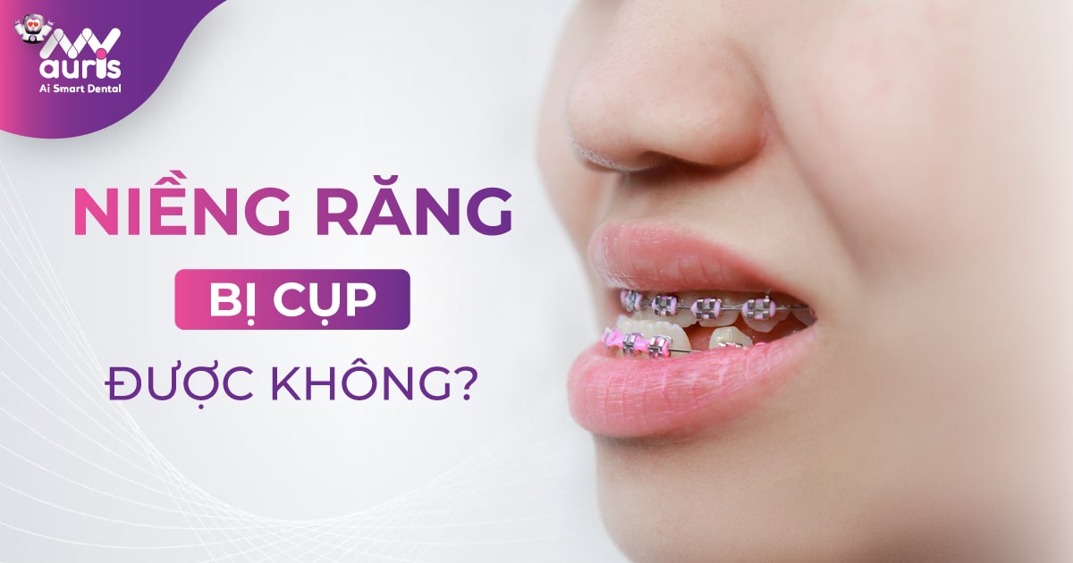 Niềng răng bị cụp được không? 4 tác hại cần chú ý