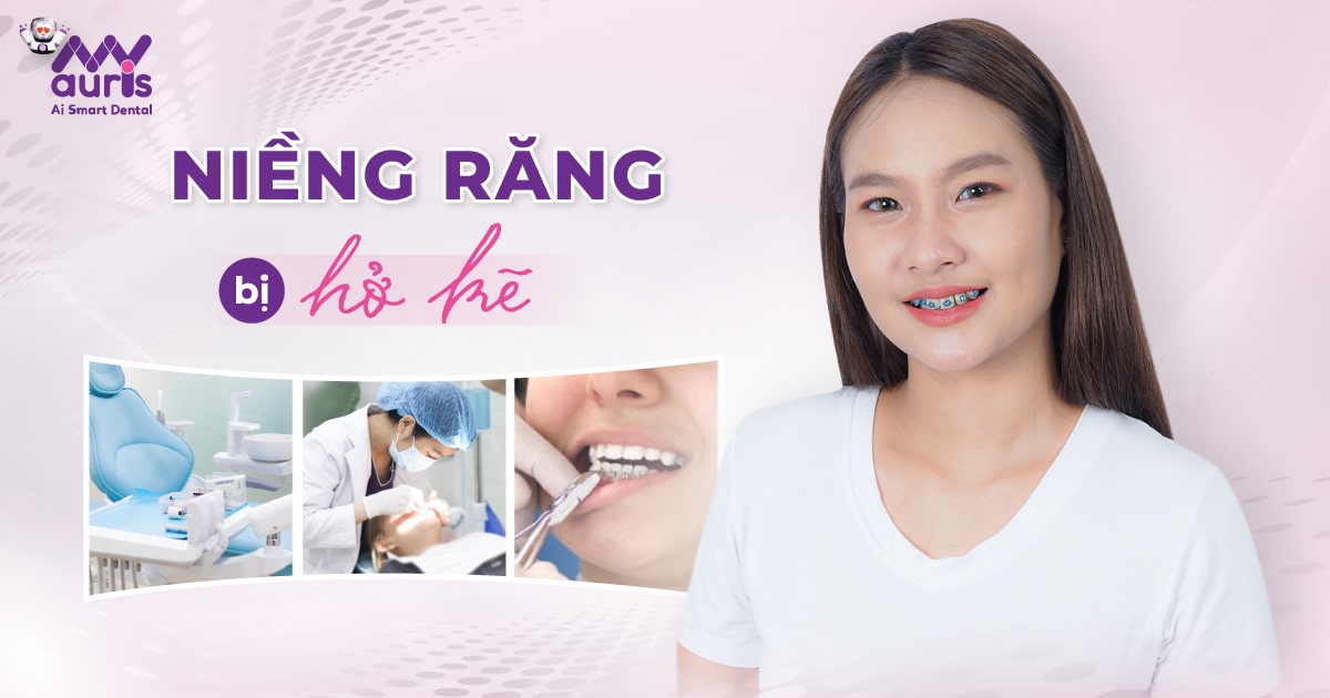 Niềng răng bị hở kẽ - Khắc phục 5 ảnh hưởng chính