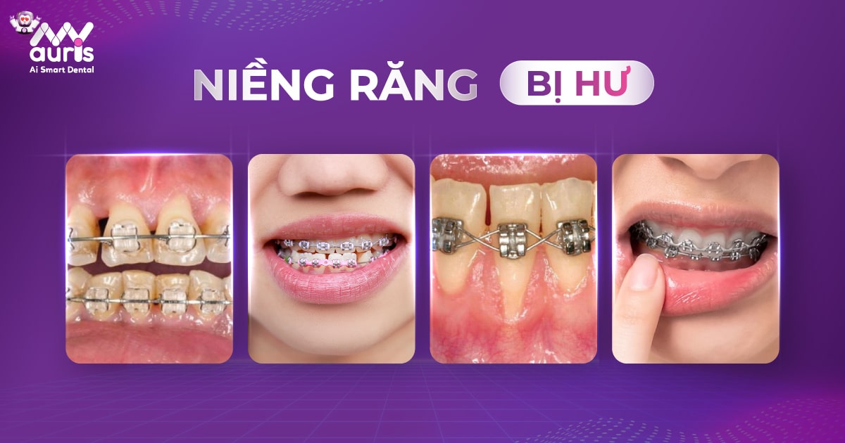 4 dấu hiệu niềng răng BỊ HƯ cần được chú ý