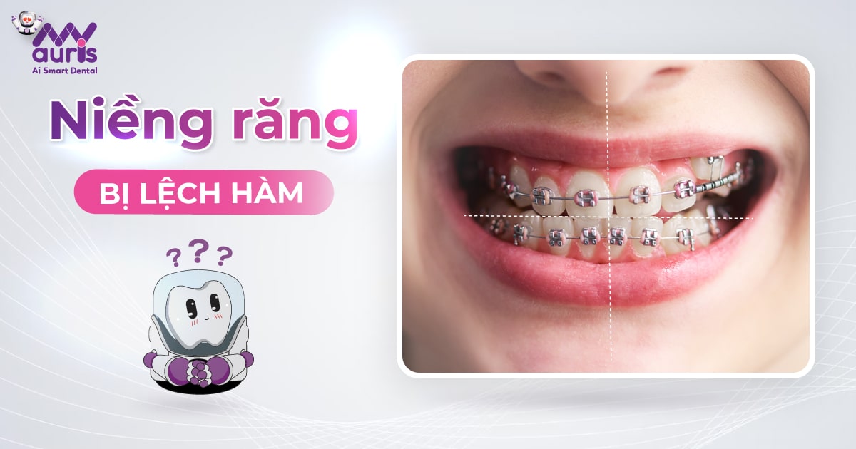 Niềng răng bị lệch hàm - 4 nguyên nhân phổ biến