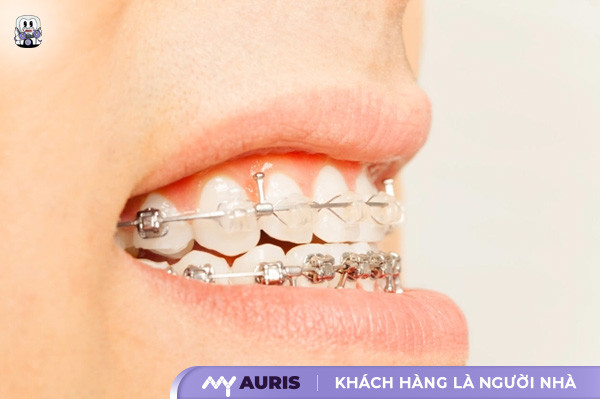 niềng răng lệch khớp cắn bao nhiêu tiền,niềng răng khớp cắn sâu bao nhiêu tiền,chi phí niềng răng khớp cắn ngược