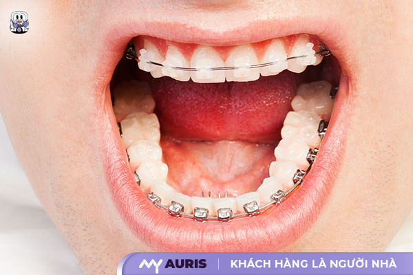 niềng răng lệch khớp cắn bao nhiêu tiền,niềng răng khớp cắn sâu bao nhiêu tiền,chi phí niềng răng khớp cắn ngược