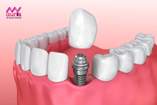 Giai đoạn gắn mão sứ lên trụ răng Implant