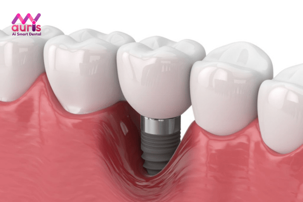 Quy trình trồng răng Implant mất bao lâu phụ thuộc vào yếu tố nào?