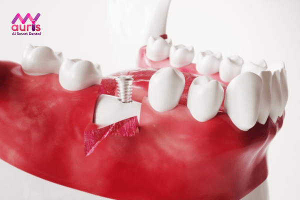 Quy trình trồng răng Implant mất bao lâu? Giai đoạn đặt trụ