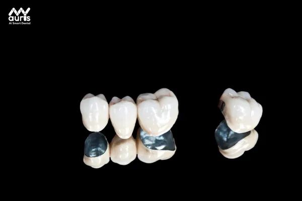 Răng sứ hợp kim titan là gì? 