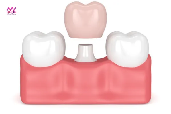 Bọc răng sứ mới - Cách khắc phục răng sứ titan bị mẻ tối ưu 
