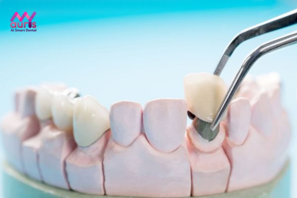 Răng sứ titan cao cấp là răng gì?
