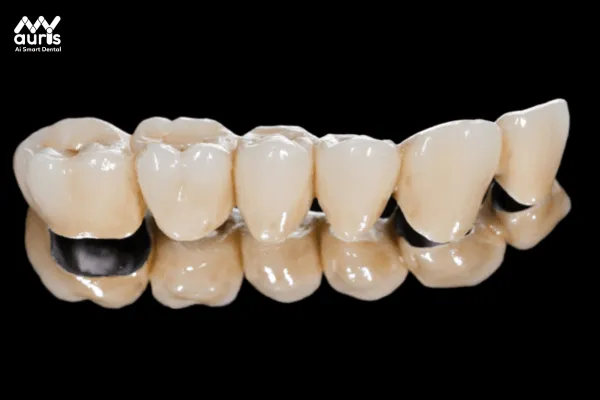 Có mấy loại răng sứ titan?