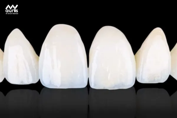 Ưu điểm vượt trội của răng toàn sứ cercon cad cam 