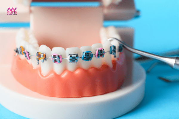 Cách ngăn ngừa sau khi niềng răng bị chạy 