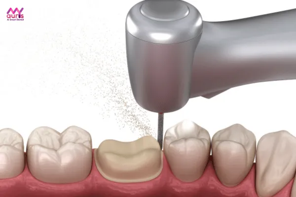 Tỷ lệ mài cùi răng sứ chính xác ở từng loại răng 