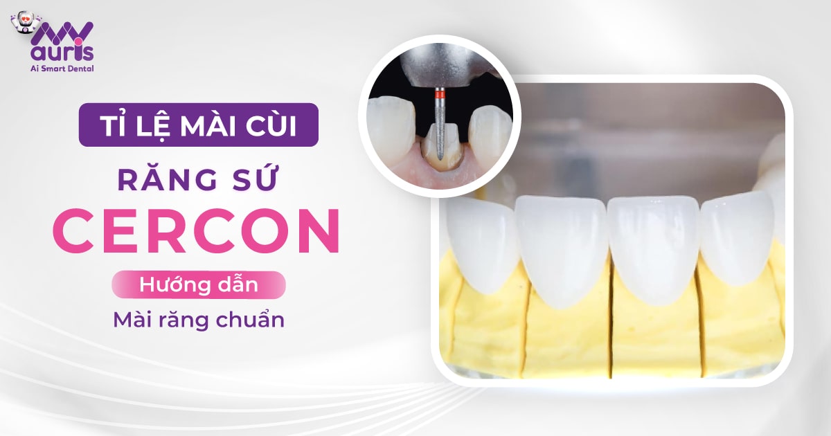 Tỉ lệ mài cùi răng sứ cercon