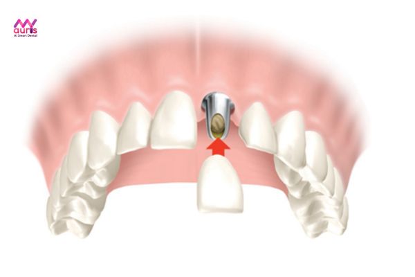 Trồng răng cửa bị hô bằng implant được không? 