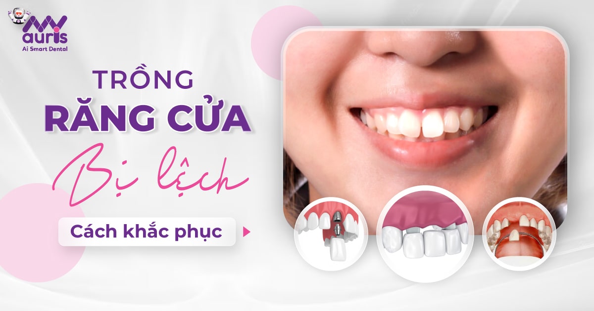 Trồng răng cửa bị lệch (3 cách khắc phục chính)