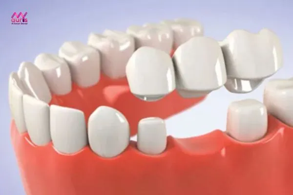Như thế nào trồng răng giả bằng cầu răng sứ?