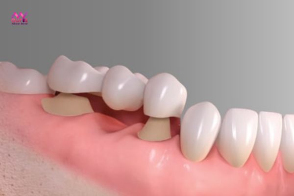 Tuổi thọ tương đối - Ưu điểm của trồng răng giả bằng cầu răng sứ