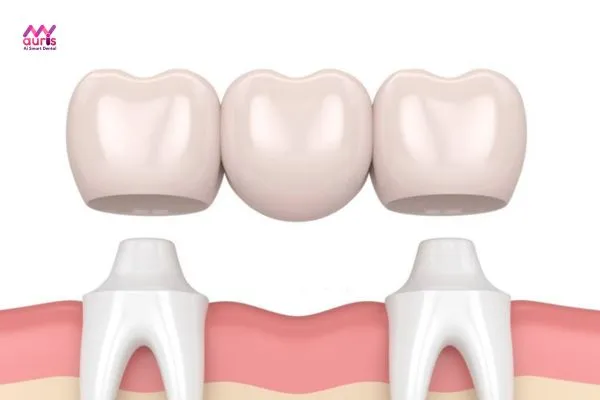 Cố định trên cung hàm - Ưu điểm của trồng răng giả bằng cầu răng sứ 