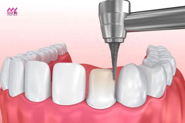 Xâm lấn răng thật - Nhược điểm của trồng răng giả bằng cầu răng sứ 