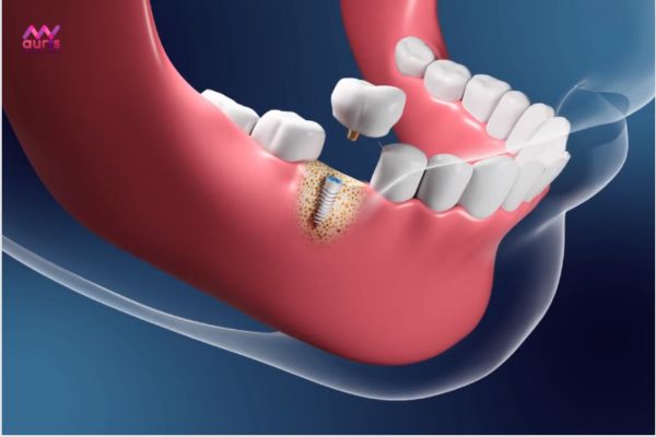 Trồng răng implant - trồng răng giả bao nhiêu 1 chiếc