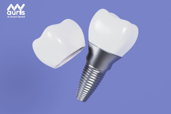 Sử dụng các dòng trụ răng Implant có nguồn gốc rõ ràng