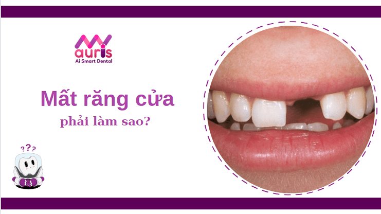 trồng răng giả răng cửa