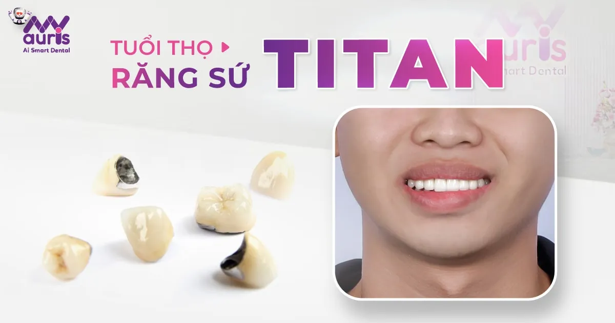 Tuổi thọ của răng sứ Titan - 3 yếu tố ảnh hưởng