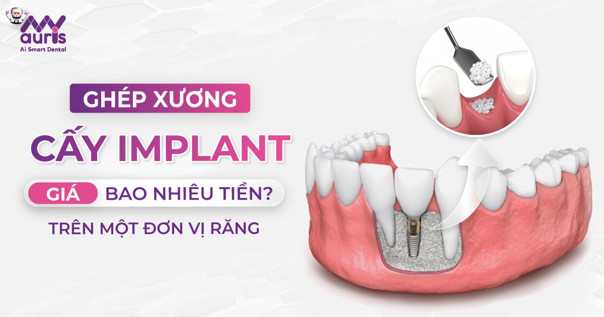 ghép xương cấy implant giá bao nhiêu